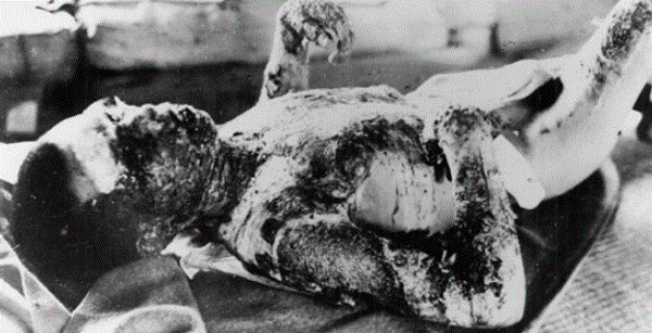 한 원폭 희생자가 원폭 투하 하루 뒤인 1945년 8월 7일 히로시마 검역소에 누워 있다. AP 연합