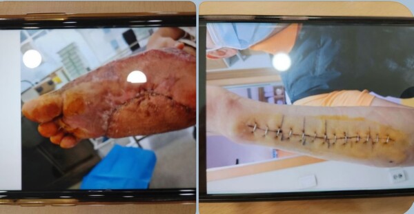 필자가 인터뷰한 반월·시화공단 이주노동자 산재 사진. 안산시비정규직노동자지원센터 제공.